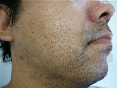 脱毛ビフォー&アフター