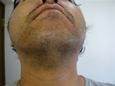 脱毛ビフォー&アフター